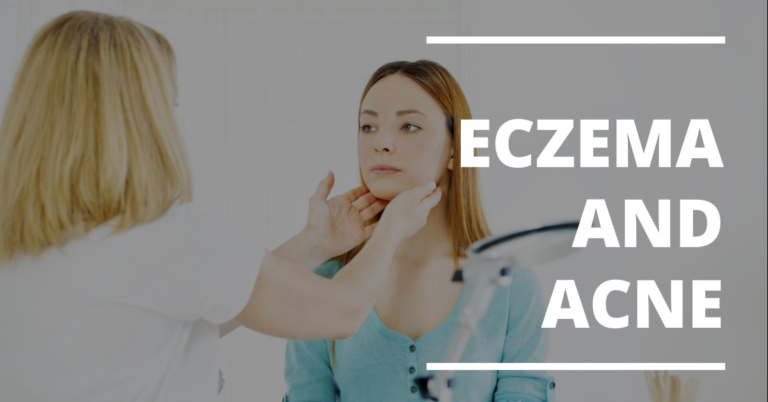 natural treatment for eczema and acne.